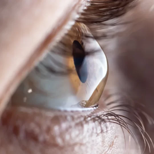 هل القرنية المخروطيةخطيرة؟ الأعراض وطرق التشخيص والعلاج