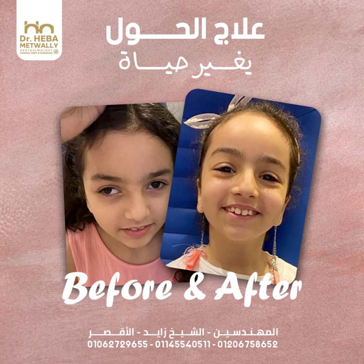علامات تدل علي إصابه طفلك بالحول